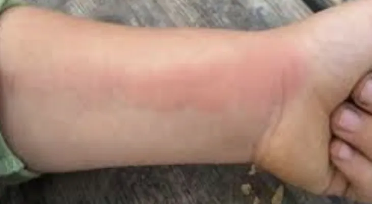 تسمم الدم... من أعراضه ظهور بقع حمراء و الشعور بحكها